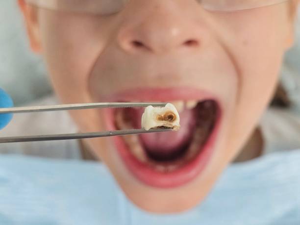 Best Emergency Tooth Extraction in Greenwood Village, CO